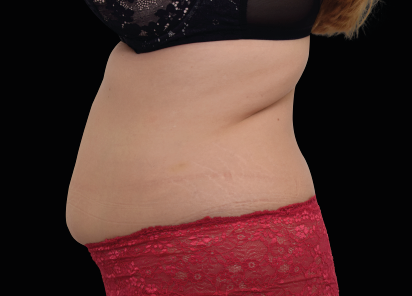 EMSculpt applicator positioned on the abdomen