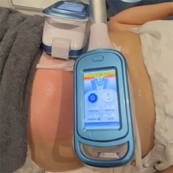 Cryolipolysis applicators in use during a treatment