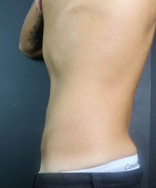 Side profile of the abdomen after Fat Freezing treatment