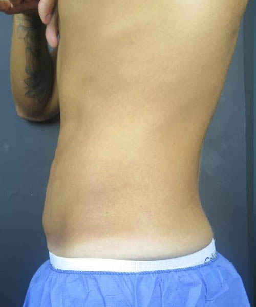 Side profile of the abdomen before Fat Freezing treatment