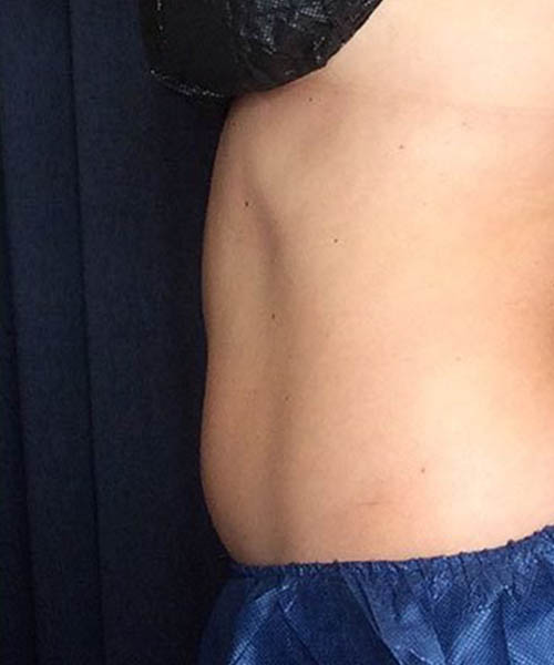 Side profile showing the stomach area after Fat Freezing treatment