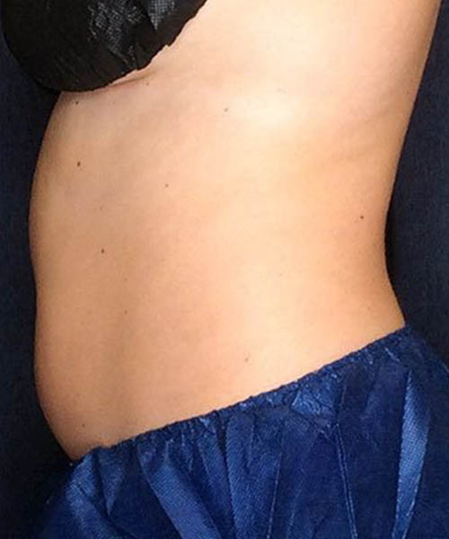 Side profile showing the stomach area before Fat Freezing treatment