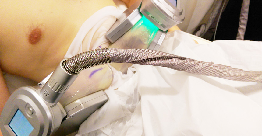 Cryolipolysis applicator positioned on the abdomen