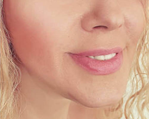 Client after HIFU Facelift treatment