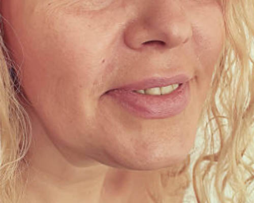 Client before HIFU Facelift treatment