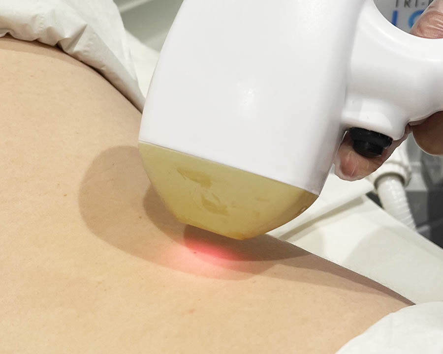 Laser hair removal applicator used on the lower leg