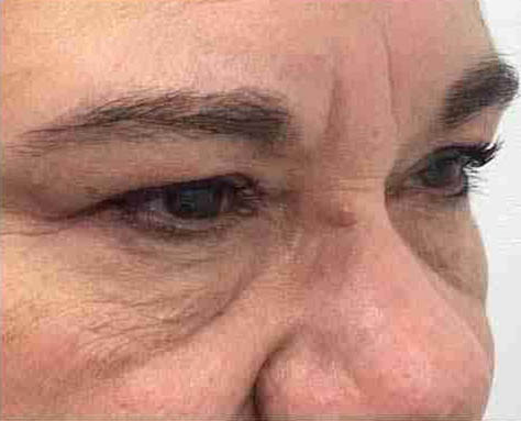 Client after Morpheus8 treatment