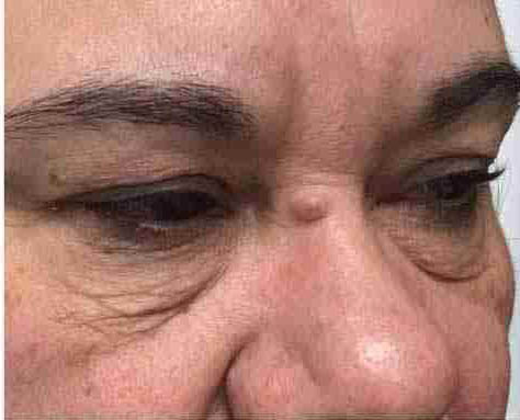 Client before Morpheus8 treatment