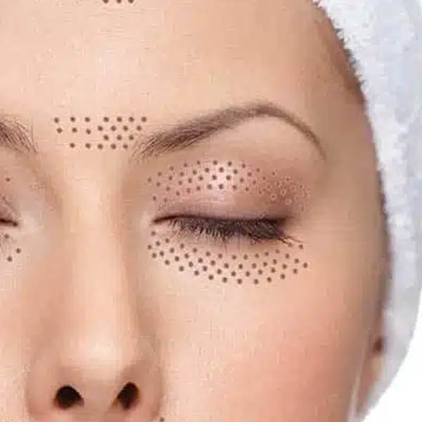 Plasma eye treatment being performed around the eyelid