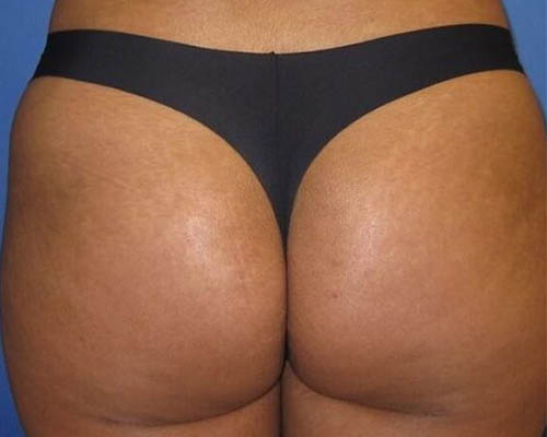 Brazilian Bum Lift After