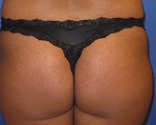 Brazilian Bum Lift Before