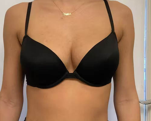 Breast Lift Before