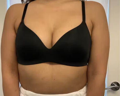 Breast Lift Before