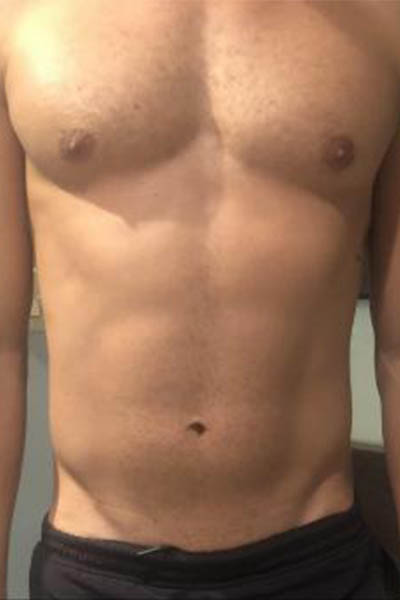 Emsculpt Before